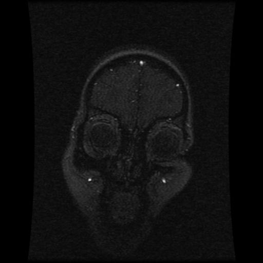 Cavernoma with developmental venous anomaly (Radiopaedia 22470-22507 MRV 110).jpg