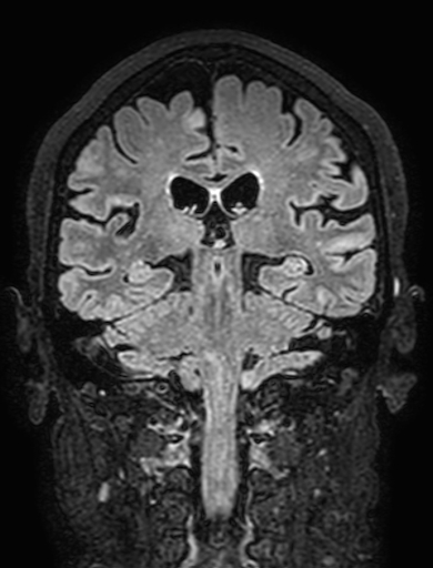 Cavernous hemangioma of the cerebellar falx (Radiopaedia 73025-83724 Coronal FLAIR 211).jpg