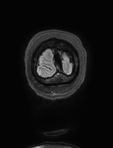 Cavernous hemangioma of the cerebellar falx (Radiopaedia 73025-83724 Coronal FLAIR 348).jpg