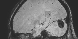 Cavernous hemangioma of the cerebellar falx (Radiopaedia 73025-83724 Sagittal BOLD 138).jpg