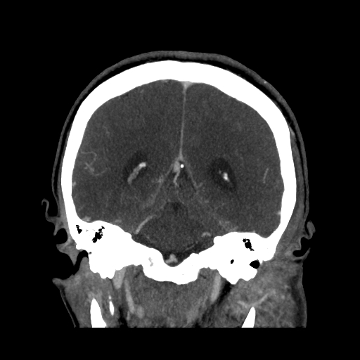 File:Cavernous sinus thrombosis (Radiopaedia 10619-11078 D 21).jpg