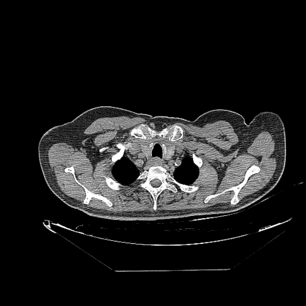 Cavitating bronchogenic carcinoma (Radiopaedia 44489-48162 Axial non-contrast 4).jpg