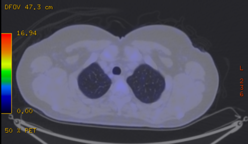 File:Cavitating lung mass - squamous cell carcinoma (Radiopaedia 48047-52853 A 19).png
