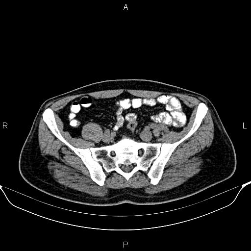 Cecal adenocarcinoma (Radiopaedia 85324-100916 Axial non-contrast 73).jpg