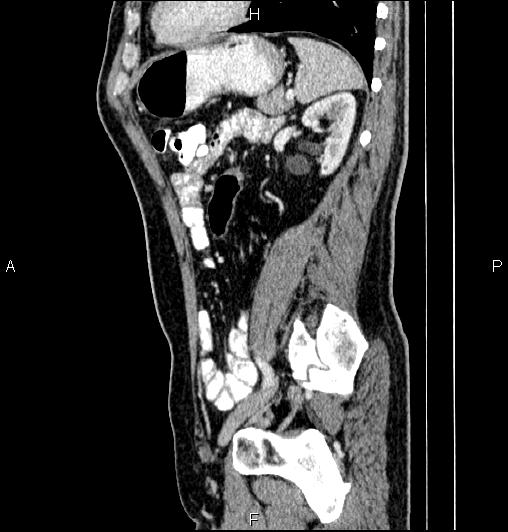 Cecal adenocarcinoma (Radiopaedia 85324-100916 E 64).jpg
