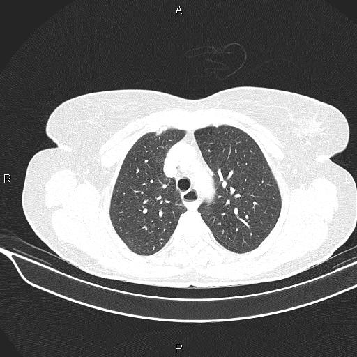 Cecal cancer (Radiopaedia 85610-101358 Axial lung window 18).jpg
