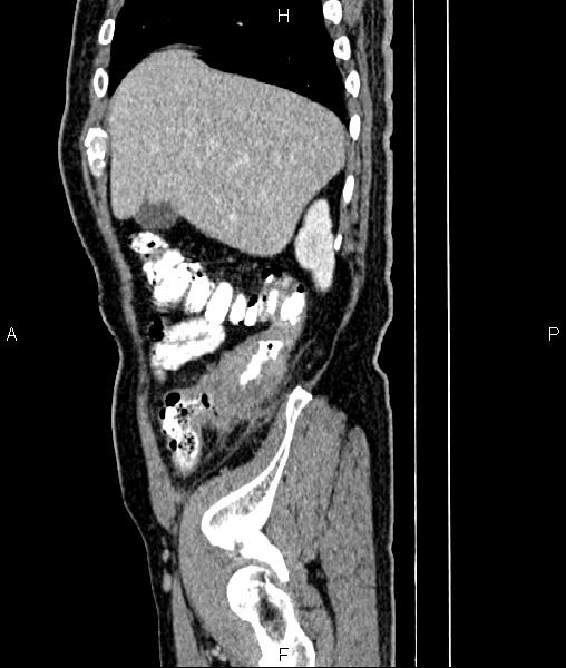 File:Cecal cancer with appendiceal mucocele (Radiopaedia 91080-108651 E 18).jpg