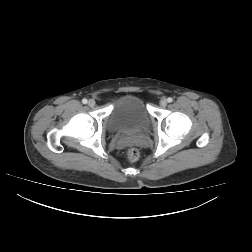 Cecal carcinoma with local lymphadenopathy (Radiopaedia 31428-32240 A 52).jpg