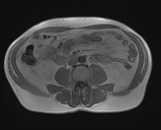 File:Cecal mass causing appendicitis (Radiopaedia 59207-66532 Axial T1 in-phase 79).jpg
