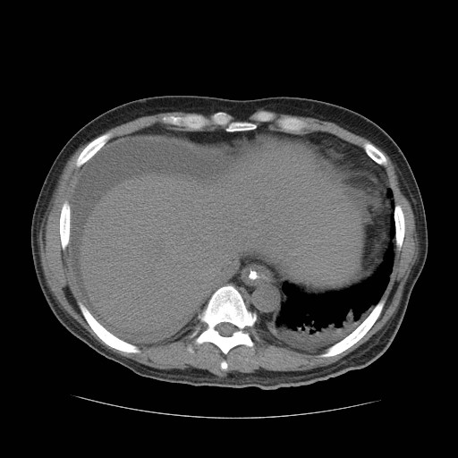 Cecal volvulus (Radiopaedia 28294-28534 Axial non-contrast 6).jpg