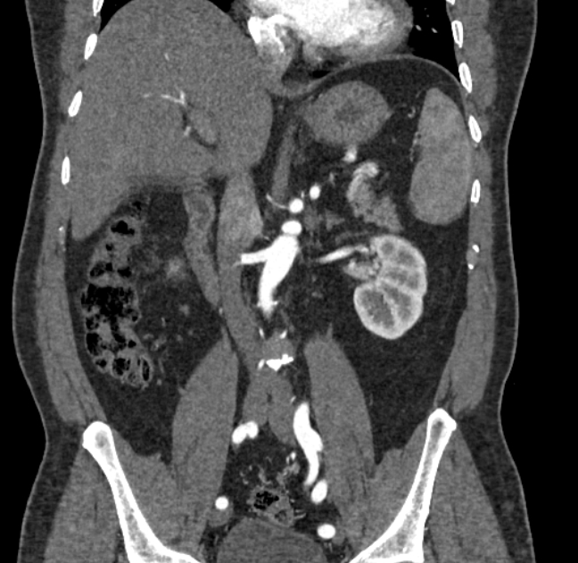 Celiac artery dissection (Radiopaedia 52194-58080 C 63).jpg