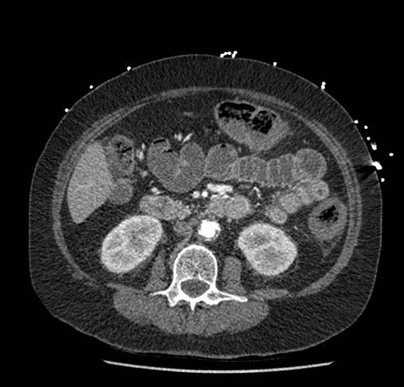 Celiac artery severe stenosis and dissection (Radiopaedia 44128-47842 B 44).jpg