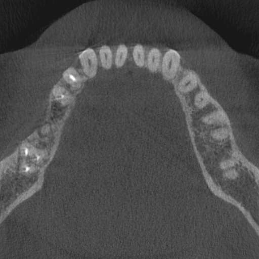 Cemento-osseous dysplasia (Radiopaedia 48251-53126 Axial non-contrast 43).jpg
