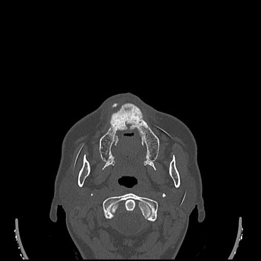 File:Cemento-ossifying fibroma (Radiopaedia 21243-21149 Axial bone window 7).jpg