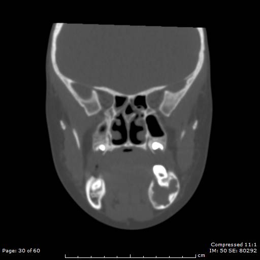 Central giant cell granuloma (Radiopaedia 45612-49754 Coronal bone window 30).jpg