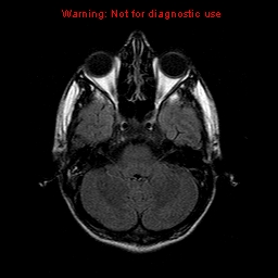 File:Central nervous system vasculitis (Radiopaedia 8410-9235 Axial FLAIR 6).jpg