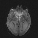 Central neurocytoma (Radiopaedia 56690-63469 Axial DWI 27).jpg