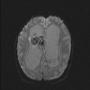 Central neurocytoma (Radiopaedia 56690-63469 Axial DWI 32).jpg