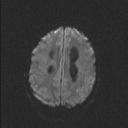 Central neurocytoma (Radiopaedia 56690-63469 Axial DWI 54).jpg
