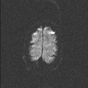 Central neurocytoma (Radiopaedia 56690-63469 Axial DWI 57).jpg