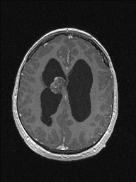 Central neurocytoma (Radiopaedia 56690-63469 Axial T1 C+ 117).jpg