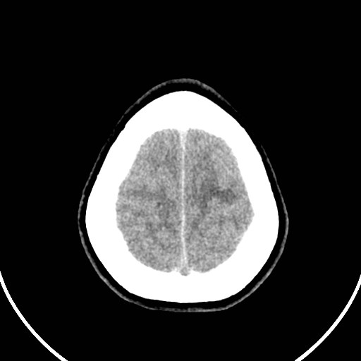 File:Central neurocytoma (Radiopaedia 84497-99871 Axial non-contrast 47).jpg