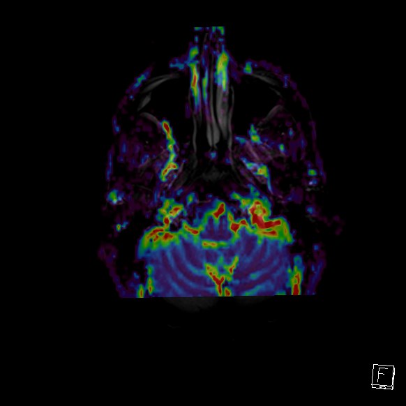 Central neurocytoma (Radiopaedia 84497-99872 Axial Perfusion 273).jpg