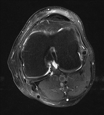 File:Central osteophyte (Radiopaedia 72592-83150 Axial PD fat sat 18).jpg