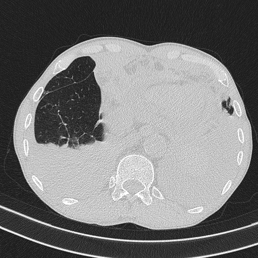 Central venous catheter tip extravasation (Radiopaedia 82828-97113 Axial lung window 71).jpg