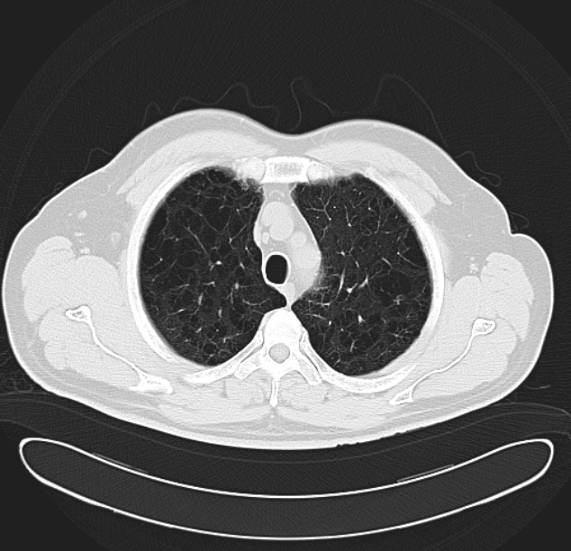 Centrilobular pulmonary emphysema (Radiopaedia 26808-26971 C 9).jpg