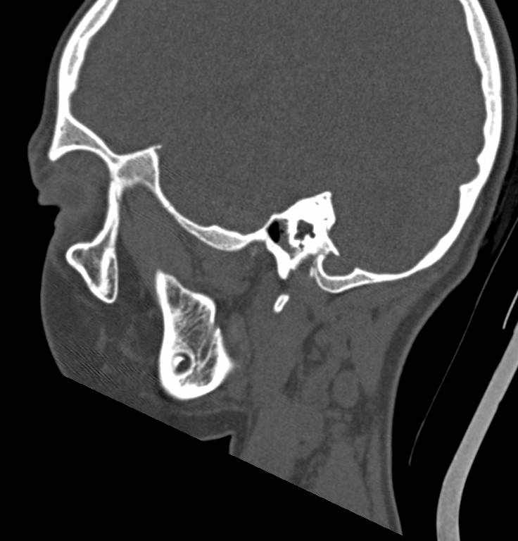 Cerebellar abscess (Radiopaedia 73727-84527 Sagittal bone window 16).jpg