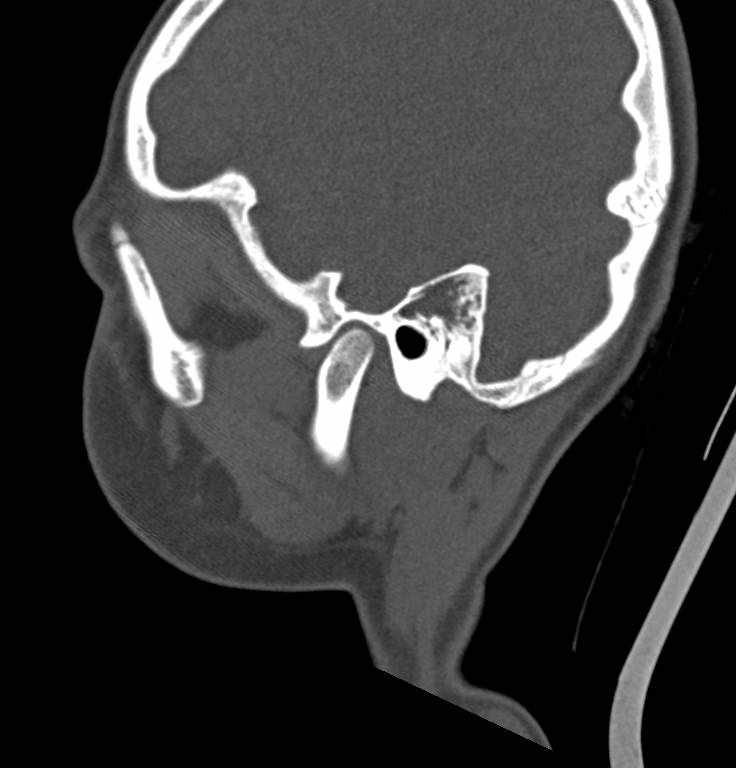 Cerebellar abscess (Radiopaedia 73727-84527 Sagittal bone window 27).jpg