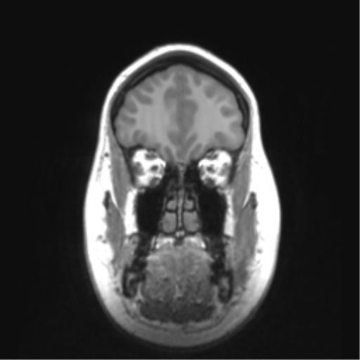 Cerebellar ependymoma complicated by post-operative subdural hematoma (Radiopaedia 83322-97736 Coronal T1 12).png