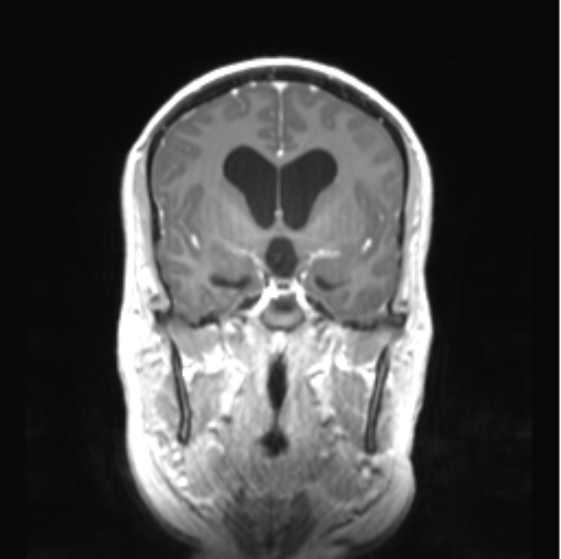 Cerebellar ependymoma complicated by post-operative subdural hematoma (Radiopaedia 83322-97736 Coronal T1 C+ 23).png