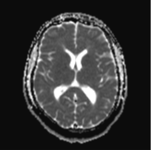 File:Cerebellar hemangioblastomas and pituitary adenoma (Radiopaedia 85490-101176 Axial ADC 19).png