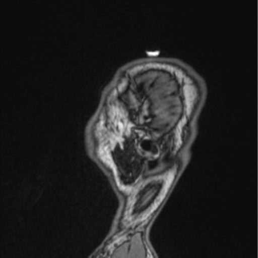 Cerebellar hemangioblastomas and pituitary adenoma (Radiopaedia 85490-101176 Sagittal T1 19).png