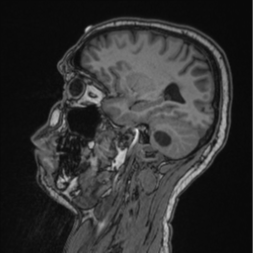 Cerebellar hemangioblastomas and pituitary adenoma (Radiopaedia 85490-101176 Sagittal T1 66).png