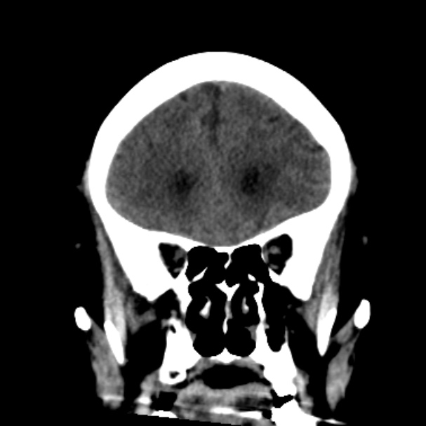 Cerebellar hemorrhage causing obstructive hydrocephalus (Radiopaedia 33989-35207 Coronal non-contrast 17).jpg