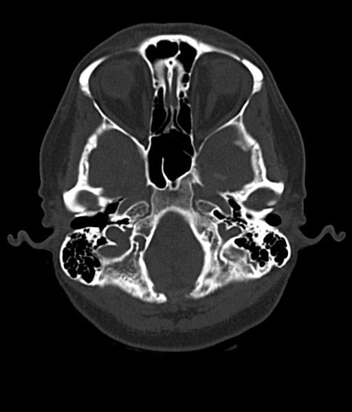 Cerebellar metastases - colorectal adenocarcinoma (Radiopaedia 40947-43652 AX Bone C- 2.0 MPR 9).png