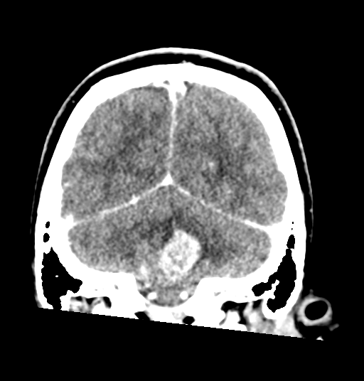 Cerebellar metastases - colorectal adenocarcinoma (Radiopaedia 40947-43652 Coronal C+ 70).png