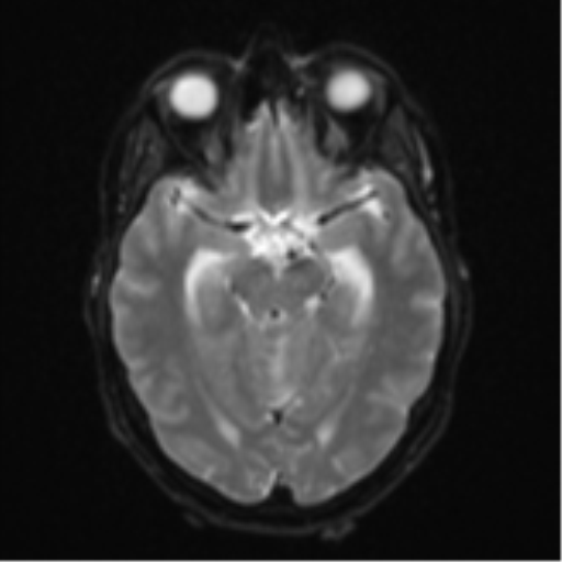 Cerebellar metastasis (Radiopaedia 51137-56765 Axial DWI 12).png