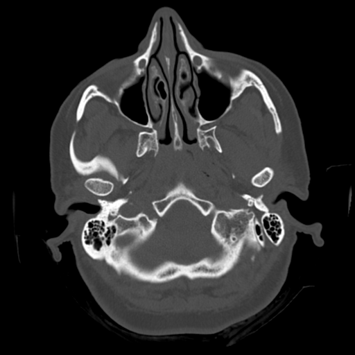 Cerebellar metastasis (cystic appearance) (Radiopaedia 41395-44258 Axial bone window 7).png