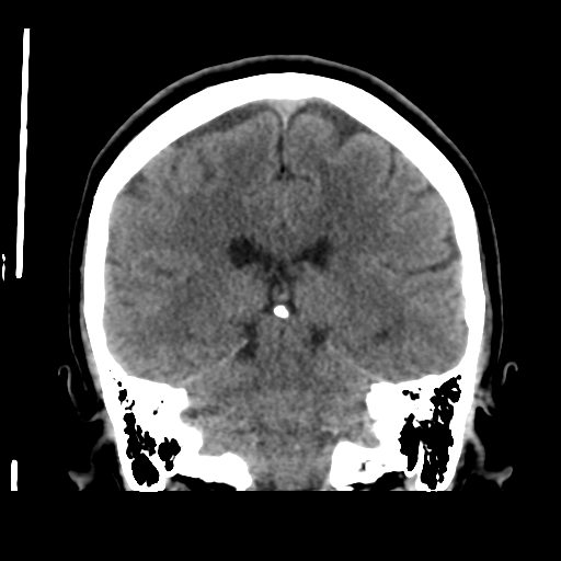 Cerebellar metastasis (cystic appearance) (Radiopaedia 41395-44258 Coronal non-contrast 39).png