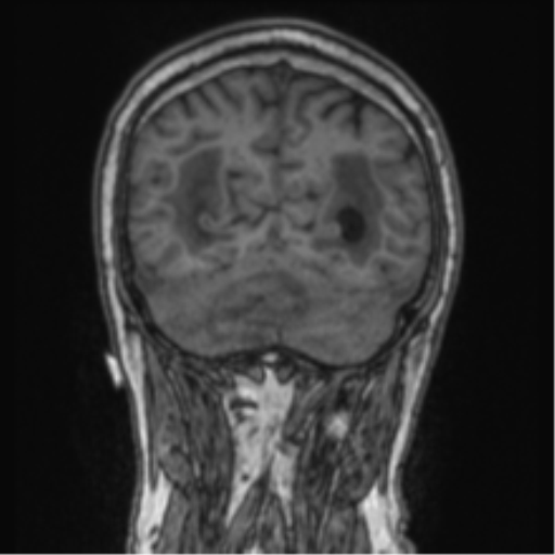 Cerebellar metastasis from lung adenocarcinoma (Radiopaedia 86690-102829 Coronal T1 25).png