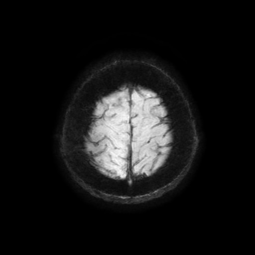 Cerebellar metastasis of pulmonary adenocarcinoma, cavernous venous malformation, and developmental venous anomaly (Radiopaedia 85827-101661 Axial SWI 10).jpg