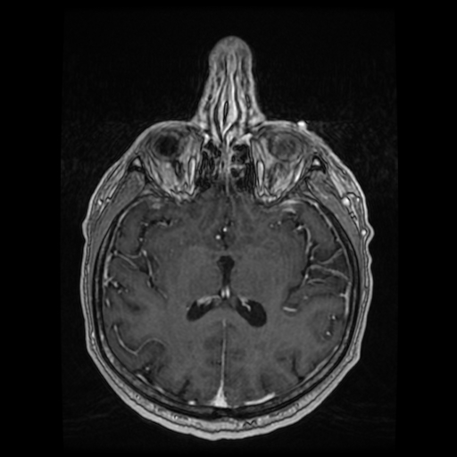 Cerebellar metastasis of pulmonary adenocarcinoma, cavernous venous malformation, and developmental venous anomaly (Radiopaedia 85827-101661 Axial T1 C+ 55).jpg