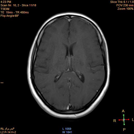 File:Cerebellopontine angle meningioma (Radiopaedia 22488-22525 Axial T1 C+ 10).jpg