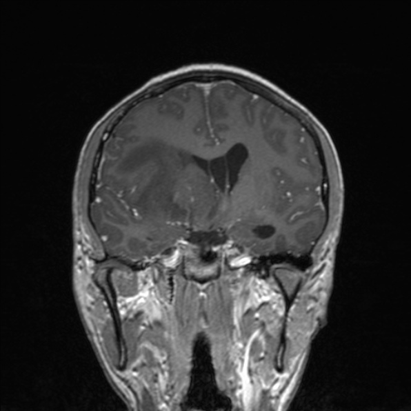 File:Cerebral abscess (Radiopaedia 24212-24478 Coronal T1 C+ 103).jpg