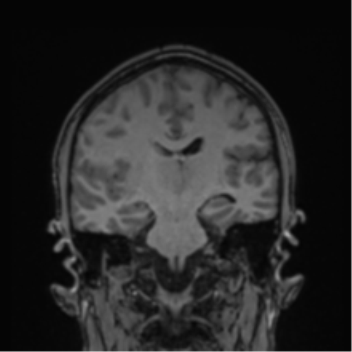 Cerebral abscess (Radiopaedia 60342-68009 Coronal T1 22).png