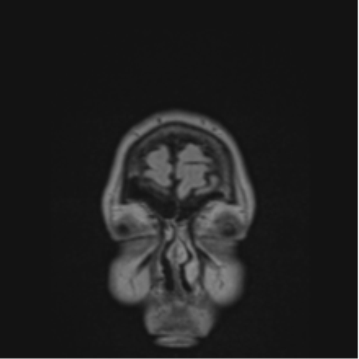 Cerebral abscess from pulmonary arteriovenous malformation (Radiopaedia 86275-102291 Coronal FLAIR 84).png